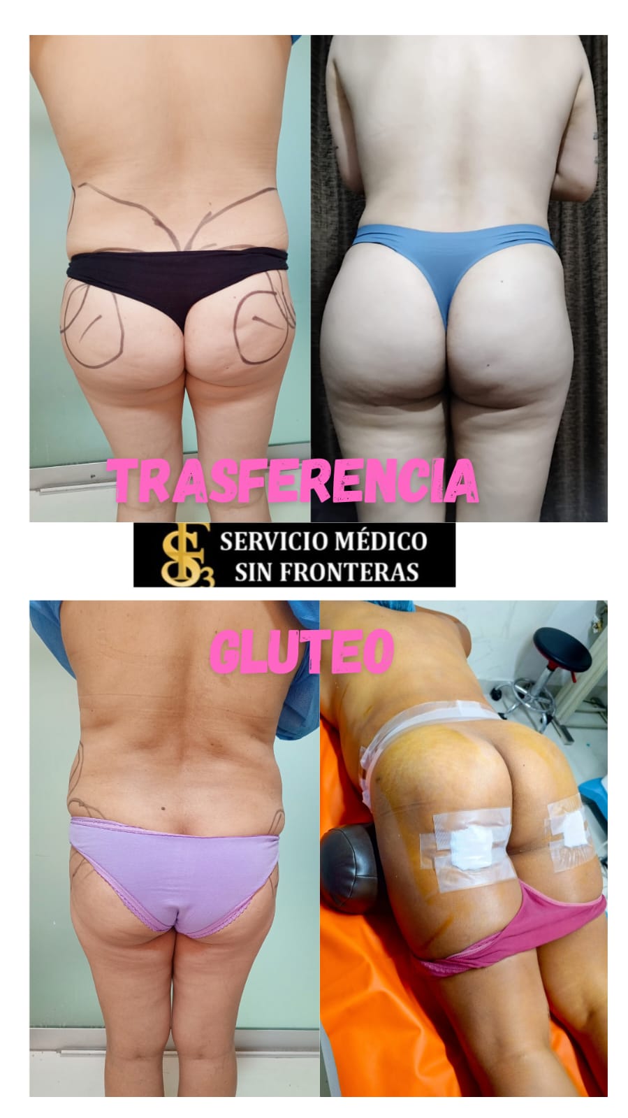 Resultado Lipotransferencia 4